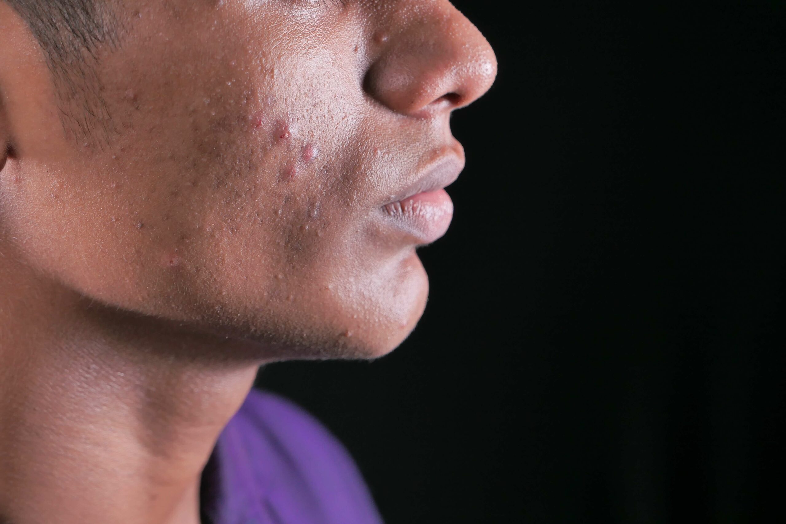 Dealing with Acne-Prone Skin