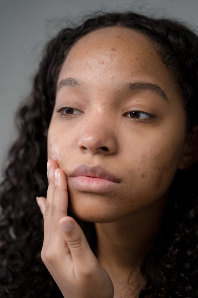 what causes hormonal acne