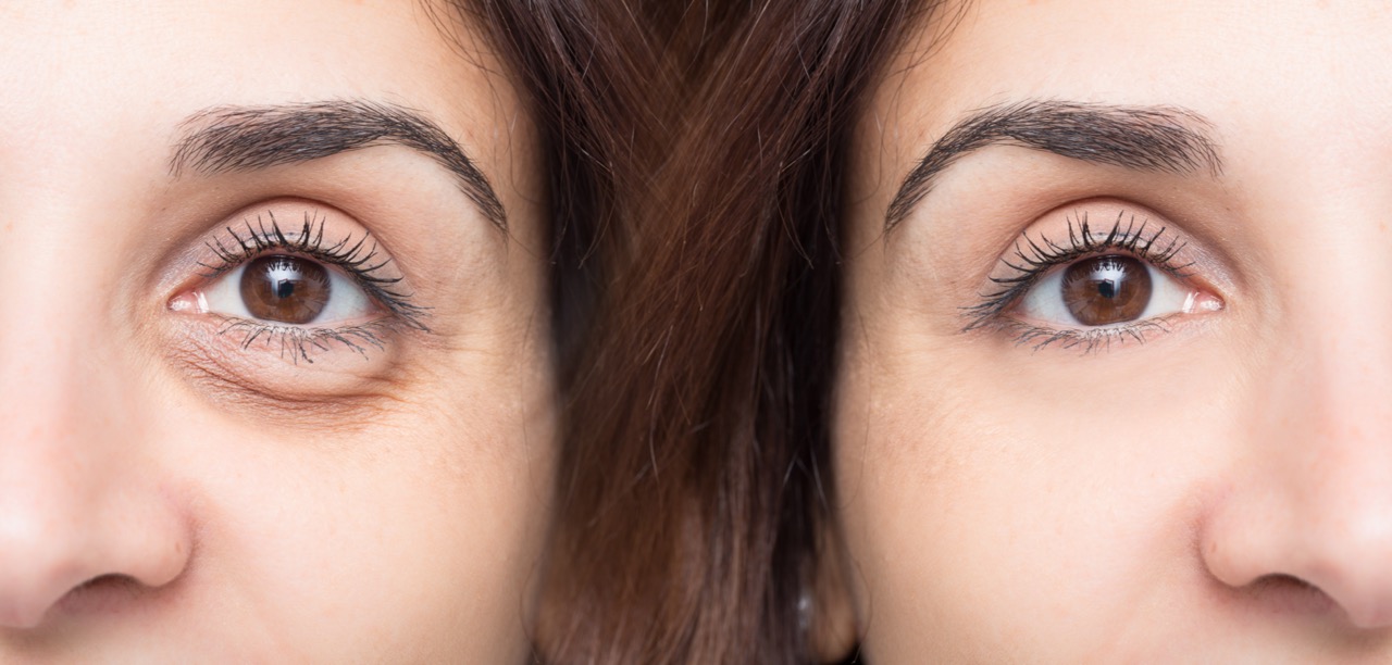 Dealing with Dark Circles