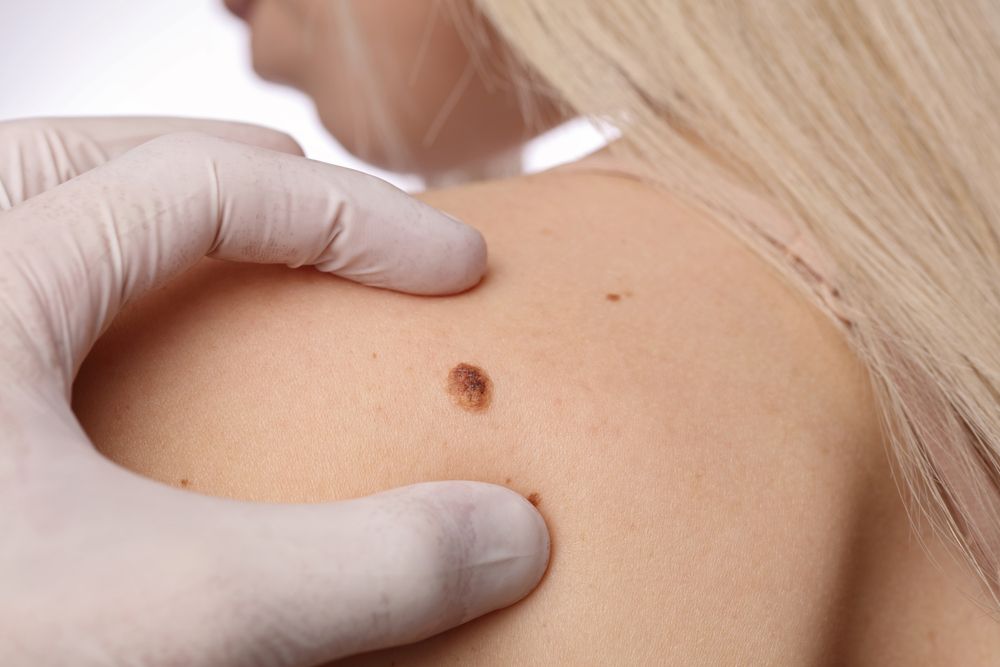 Moles
