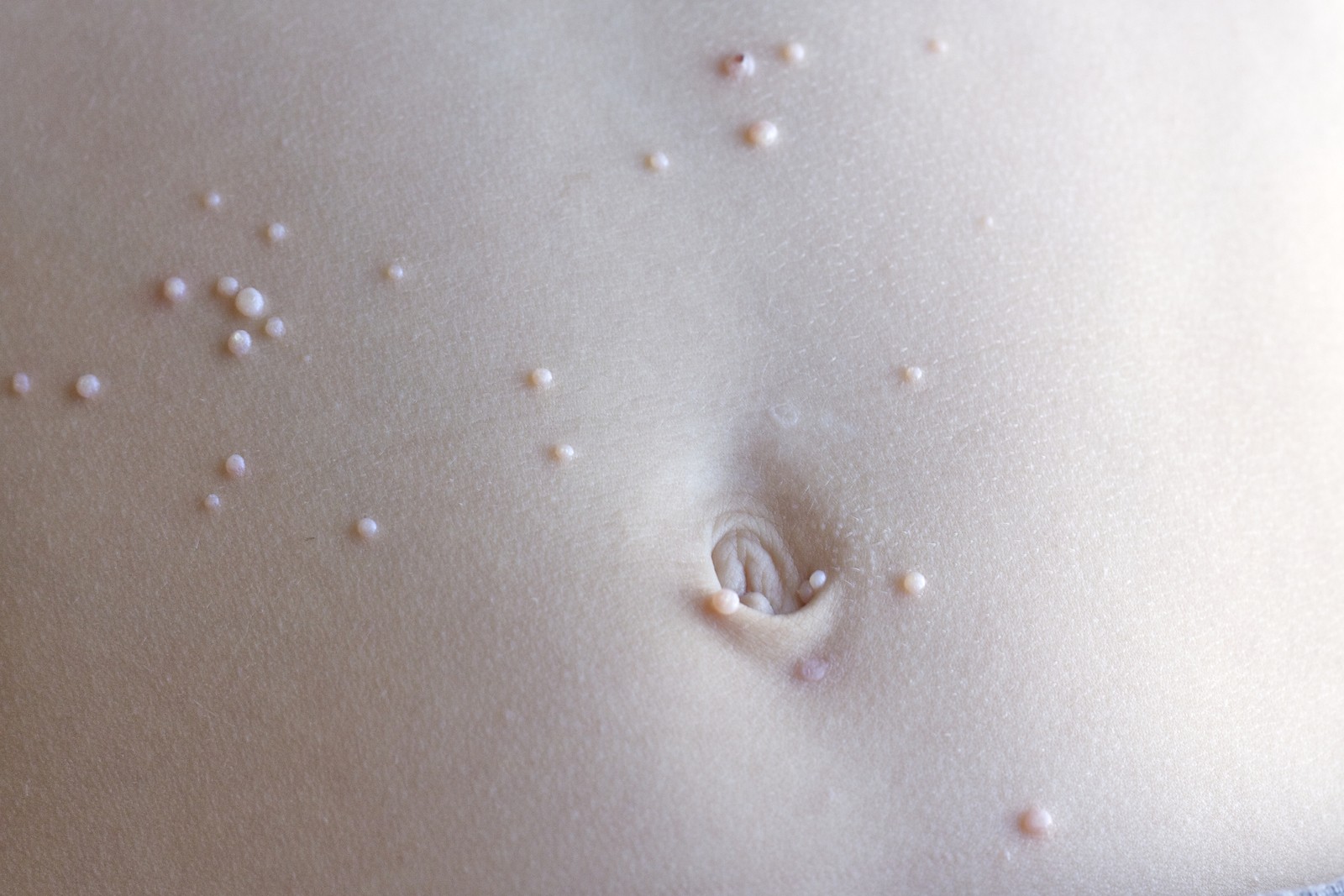 Molluscum Contagiosum