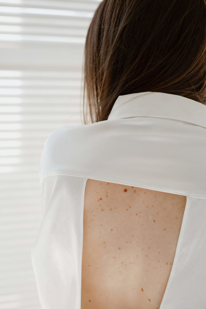 Skin Moles on a Woman's Back - Northwest Dermatology Group