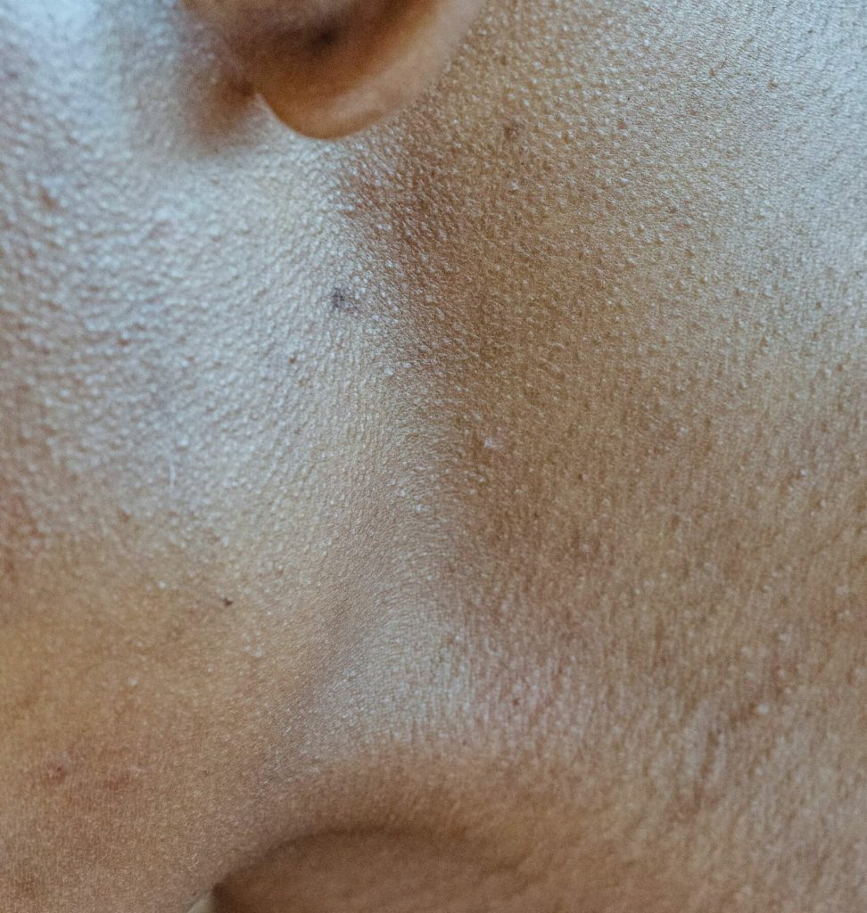 Three Skin Conditions—Milia, Whiteheads, Fungal Acne Northwest